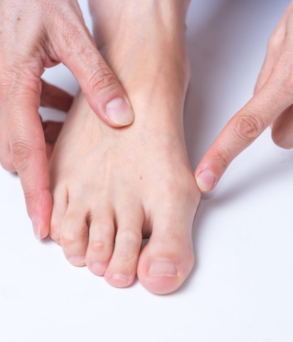 Bunion,On,Foot,,Arthritis,,Health,,Body,Medicine,,Close,Up